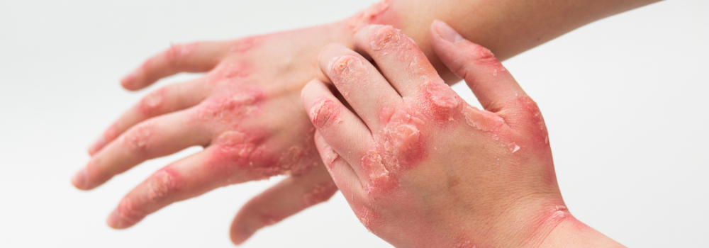Eczema: learn what it is and how to care for your skin.