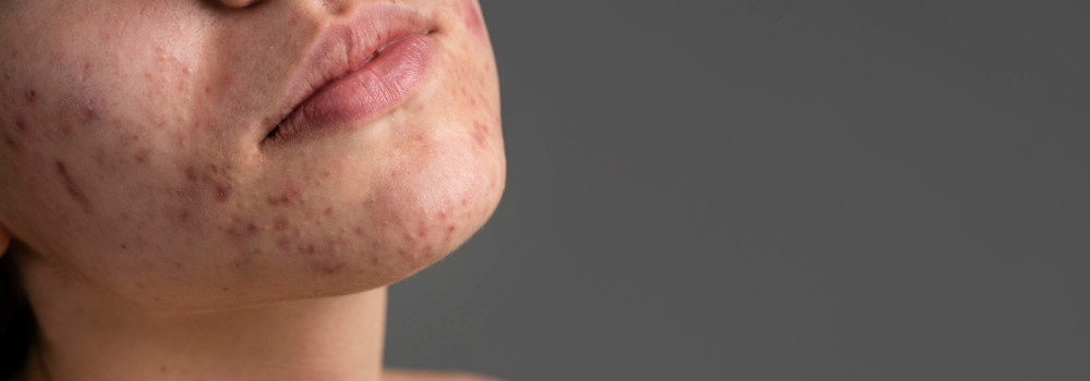 How to Care for Acne-Prone Skin