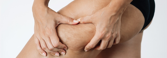 Cellulite: The Complete Guide to Reducing and Smoothing Your Skin Before Summer