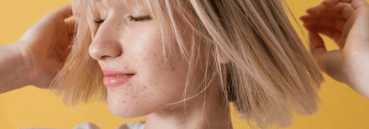The Best Sunscreens for Acne Prone Skin - Sunshine and Selfies - Healtsy
