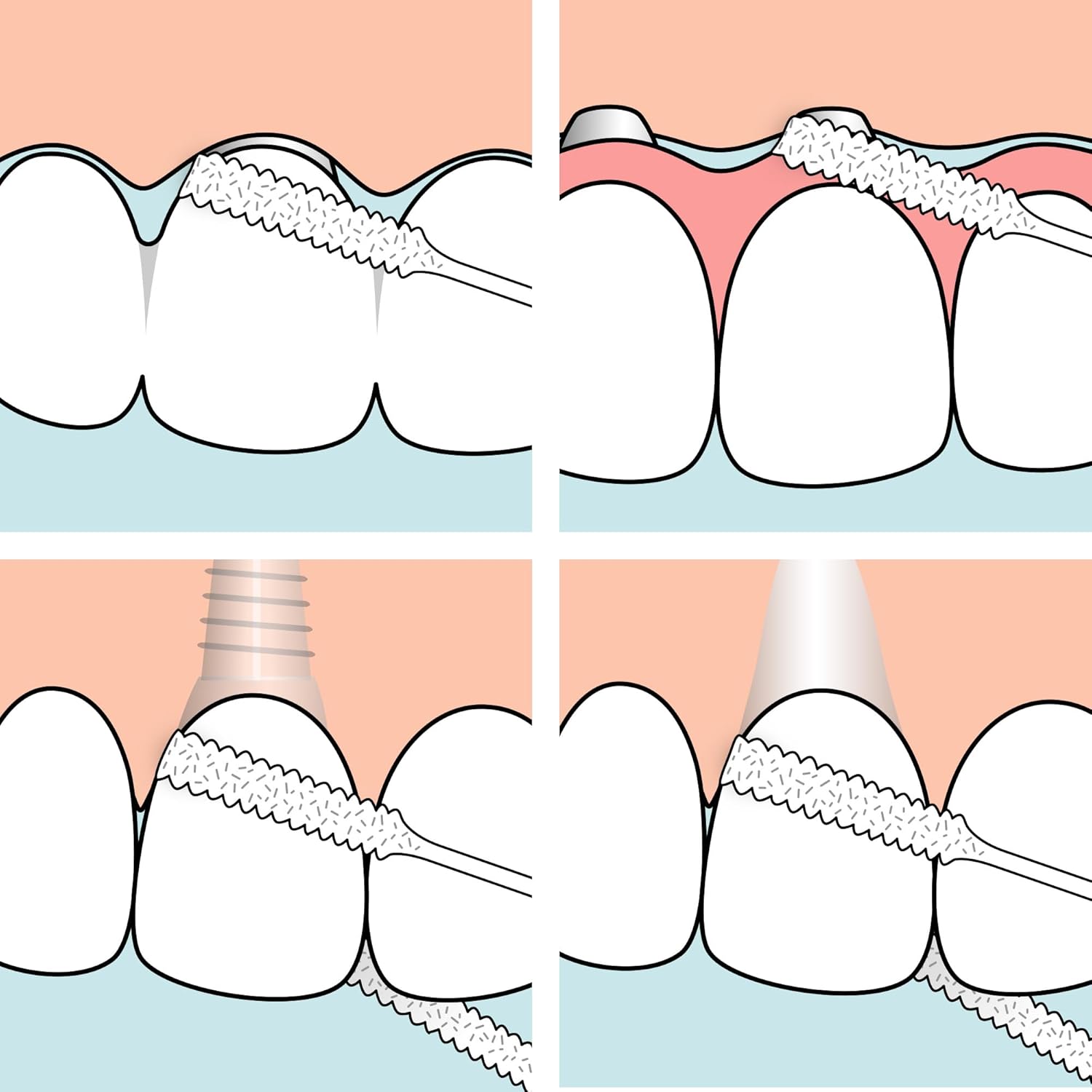 Tepe Wire For Bridge Floss Implants (x30 pcs) - Healtsy
